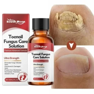 Fungal Nail Treatment Serum Nails Fungus Removal Treating Paronychia Liquid Anti Gray Nails Toe Infection Foot Repair Care Tools